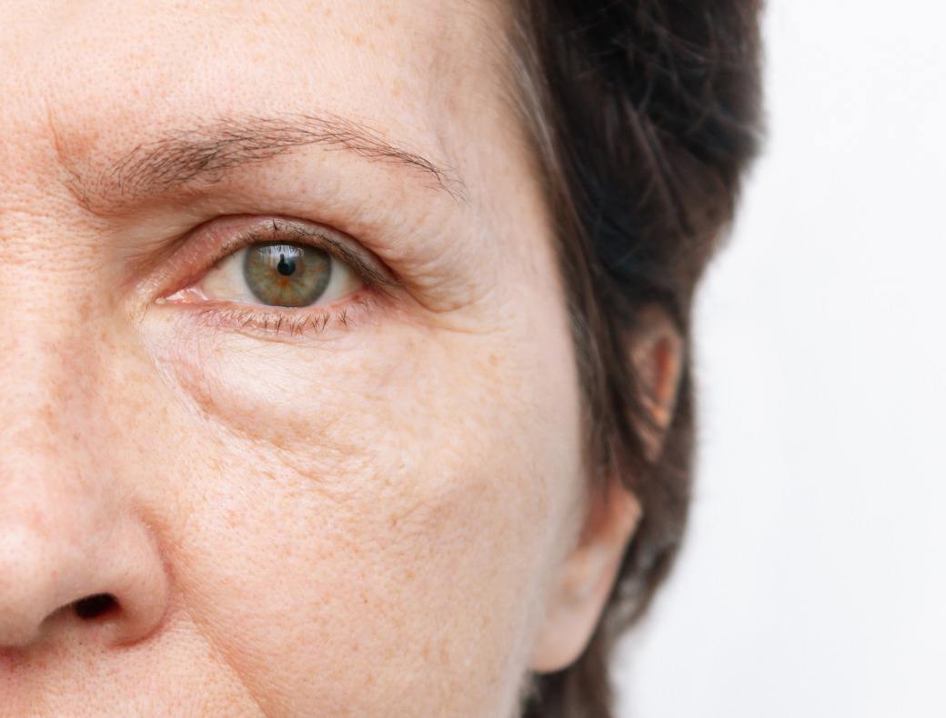 Bags under eyes, Symptoms & Causes